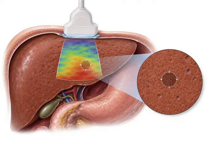Liver elastography kPa